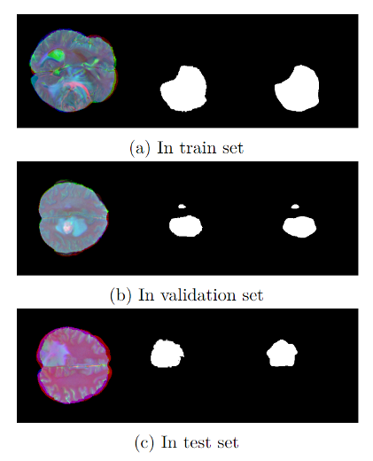 Stack (T1/T2/FLAIR as 3 channels) — train / validation / test